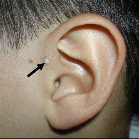 Rappresentazione sindrome BOR