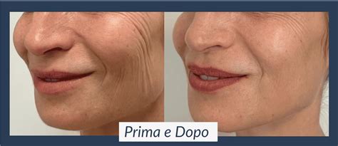 Benefici della biorivitalizzazione