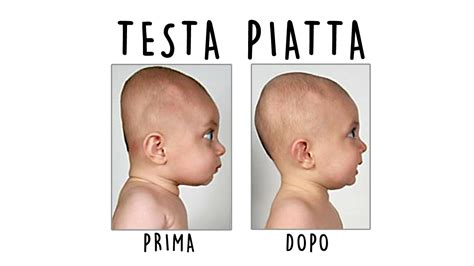 Sindrome della testa piatta nel neonato