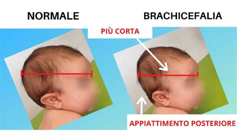 Esercizi e posizionamento per la prevenzione della testa piatta