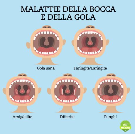 Sintomi comuni della faringite streptococcica nei bambini