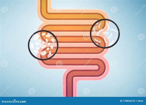 Illustrazione schematica dell'intestino con una sezione invaginata