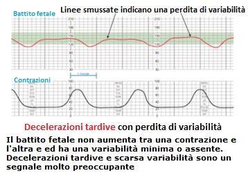 Schema delle diverse tipologie di decelerazioni CTG (precoci, variabili, tardive)
