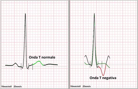 Onda flussimetrica normale vs. alterata dell'arteria uterina con notch