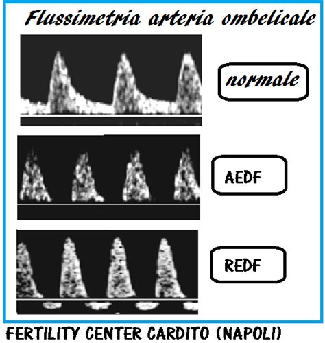 Onda flussimetrica normale vs. assente/invertita dell'arteria ombelicale
