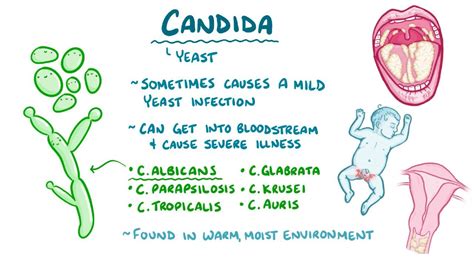 Infografica sulle cause della candida