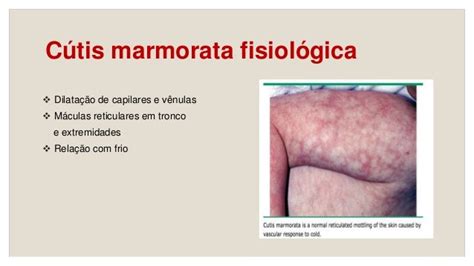 Cutis Marmorata fisiologica