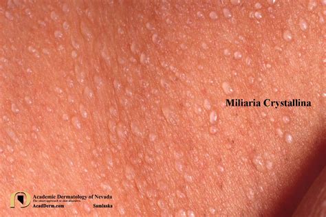 Miliaria e Milia nel neonato