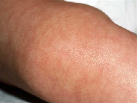 Cutis Marmorata Teleangectasica Congenita