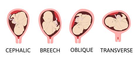 Schema illustrativo della percezione sonora del feto all'interno dell'utero