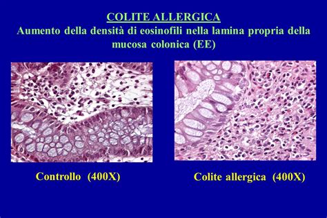 Diagramma del meccanismo della colite allergica
