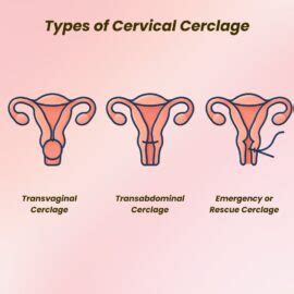 Diagram illustrating cervical cerclage procedure