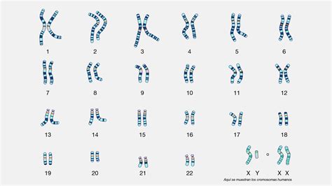 Esempio di cariotipo fetale con anomalia cromosomica (Trisomia 21)