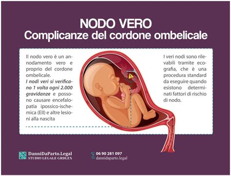 Nodi veri del cordone ombelicale
