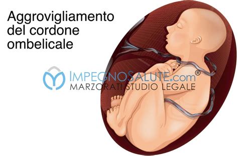 Feto con cordone ombelicale attorno al collo