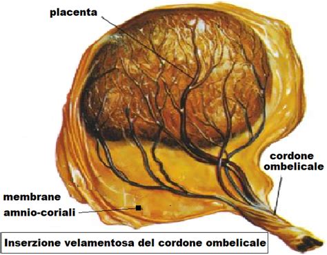 anatomia del cordone ombelicale con inserzione velamentosa