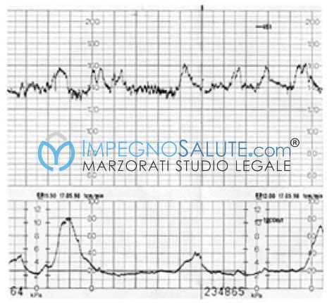 schema del monitoraggio cardiotocografico in caso di sospetta sofferenza fetale