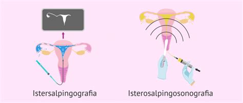 Schema di isterosalpingografia che mostra il percorso del liquido di contrasto