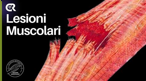 Immagine che illustra le lesioni tipiche dell'endometriosi