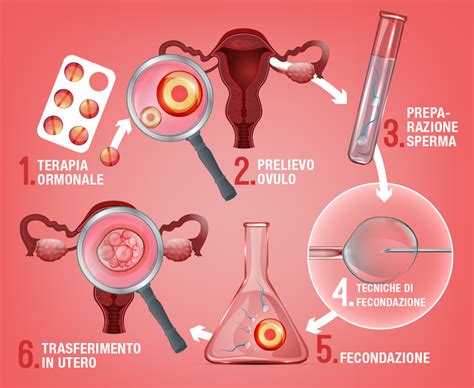 Tecniche di procreazione medicalmente assistita