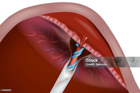 Illustrazione del sanguinamento vaginale nella placenta previa
