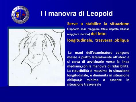 Rappresentazione della manovra di Leopold