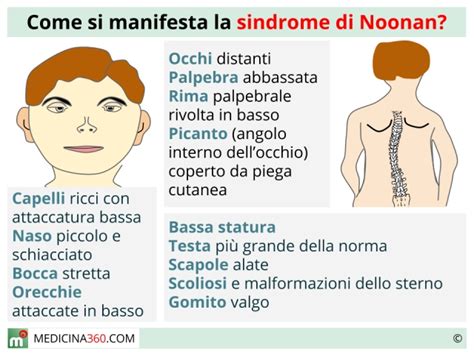 Sintomi comuni della Sindrome di Noonan