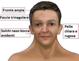 Dismorfismi scheletrici nella Sindrome di Noonan