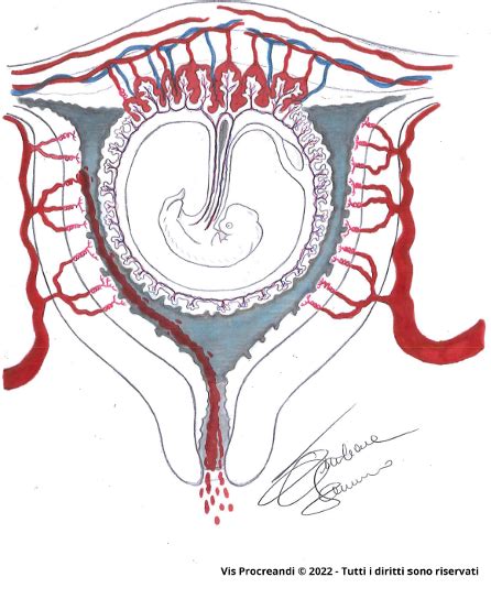 rappresentazione stilizzata dell'anatomia uterina durante le prime fasi della gestazione