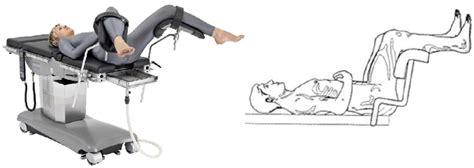 litotomica vs posizioni verticali