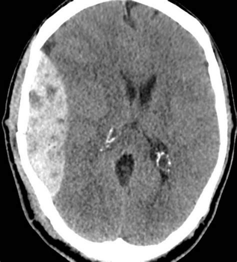 Immagine TC di un ematoma epidurale con tipica forma a lente biconvessa