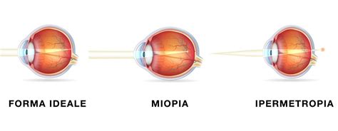Rappresentazione schematica dell'occhio miope e della retina allungata