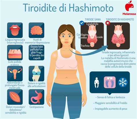 Basedow-Graves vs Tiroidite di Hashimoto