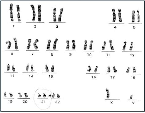 rappresentazione del cariotipo umano con trisomia 21