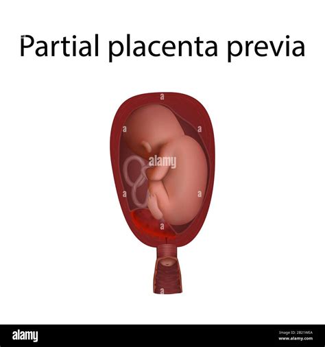 Illustrazione di una Placenta previa