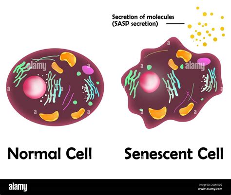 Placenta con segni di senescenza e calcificazioni