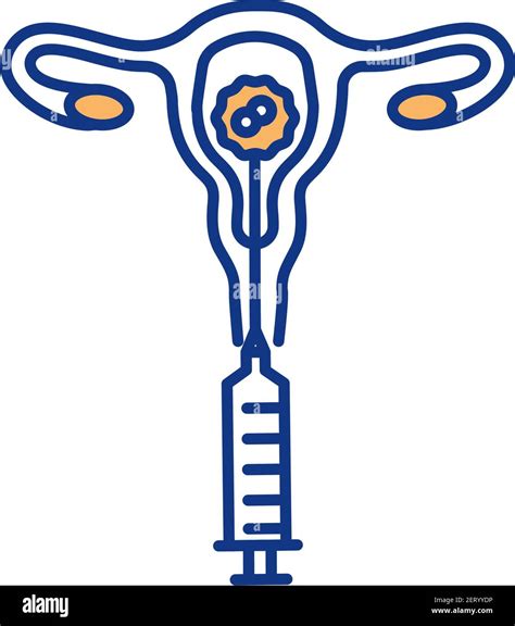 rappresentazione schematica dell'apparato riproduttivo femminile durante la procedura di inseminazione