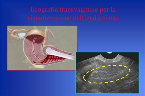 rappresentazione schematica di un'ecografia transvaginale con visualizzazione dell'utero e delle ovaie