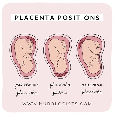 grafico che illustra le diverse posizioni placentari: normale, bassa e previa