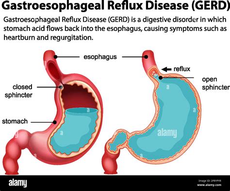 illustrazione schematica della posizione del corpo durante il reflusso gastroesofageo