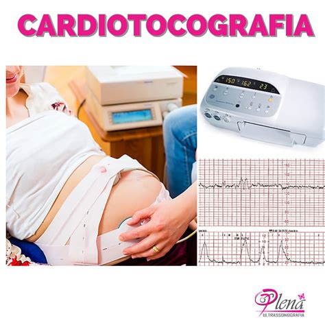 schema del monitoraggio cardiotocografico durante il parto gemellare
