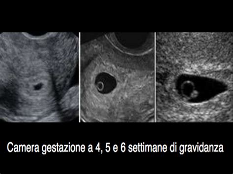 Ecografia di una camera gestazionale vuota