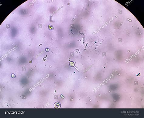 Microscopio che mostra Trichomonas vaginalis e cellule di Candida albicans