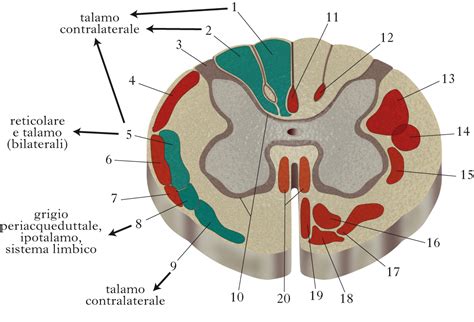 schema anatomico del canale spinale e della localizzazione epidurale dell'ematoma