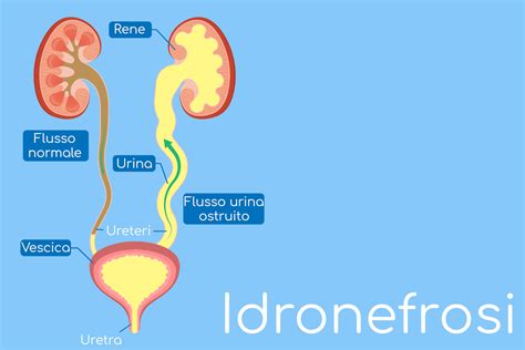 rappresentazione anatomica di un rene con idronefrosi in cui si nota la dilatazione della pelvi