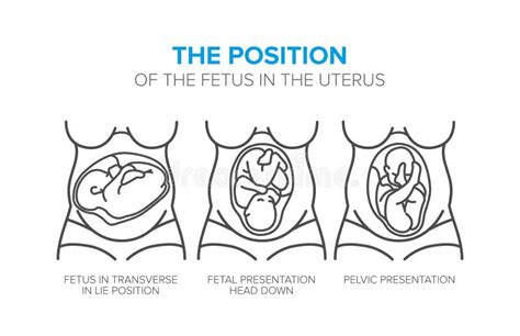 illustrazione anatomica dell'utero in gravidanza che mostra la posizione del feto