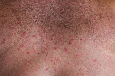 Eruzione da calore (Miliaria)