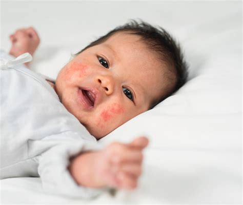 Dermatite atopica in neonato