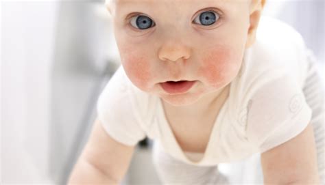 Bambino con guance rosse