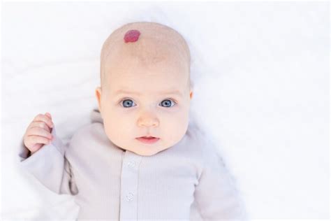 Emangioma infantile